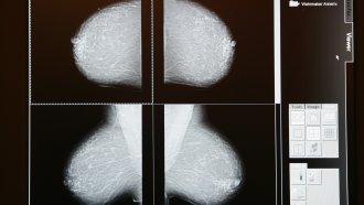 New Gene Mutations For Breast Cancer Discovered