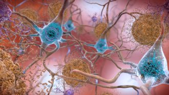 An image of cells in an Alzheimer’s affected brain.
