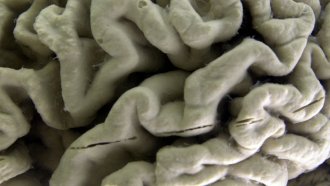 An image of a brain affected by Alzheimer's disease