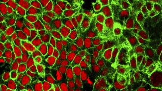 Human colon cancer cells with the nuclei stained red.