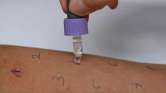 The arm of a patient is being treated with samples of an allergy test.