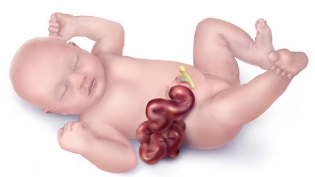 A graphic of a baby born with gastroschisis.