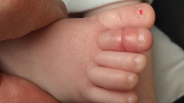 A picture of a baby's swollen toe.