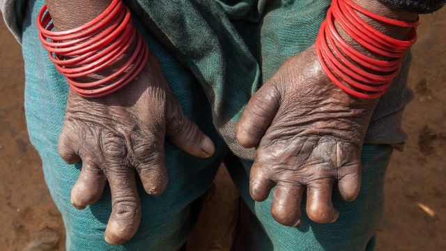 A woman affected by leprosy shows her hands outside a self care house provided by Leprosy Mission Nepal near the Anandaban Ho