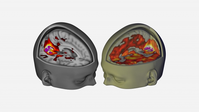 An image from Imperial College London researchers comparing brain scans of a sober person (left) and one on LSD (right).