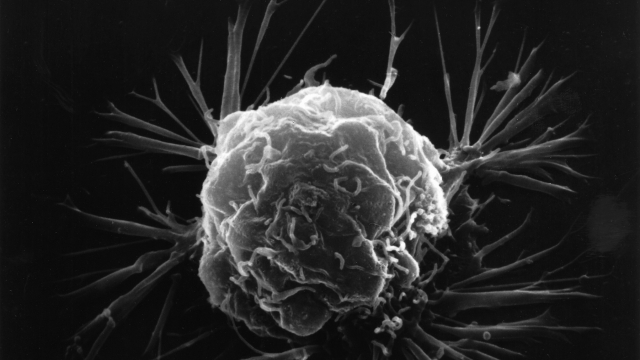 An image of a breast cancer cell.