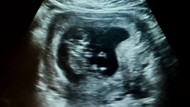 A baby is shown on a sonogram.