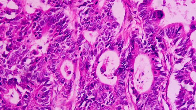 A biopsy of a tumor