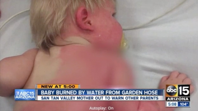 An Arizona child suffered second-degree burns