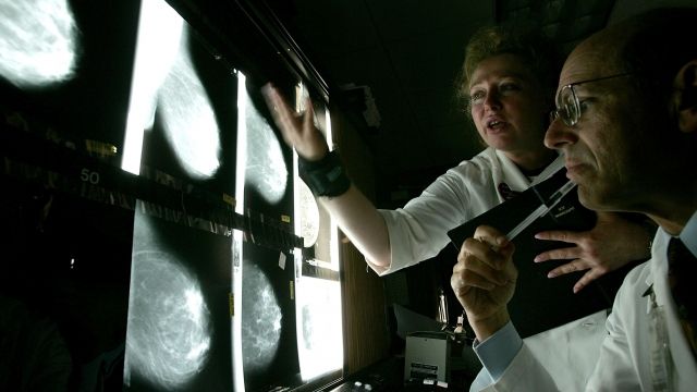Dr. Edward Sickles MD (R) and Larisa Gurilnik RT look at films of breast x-rays at the UCSF Comprehensive Cancer Center.
