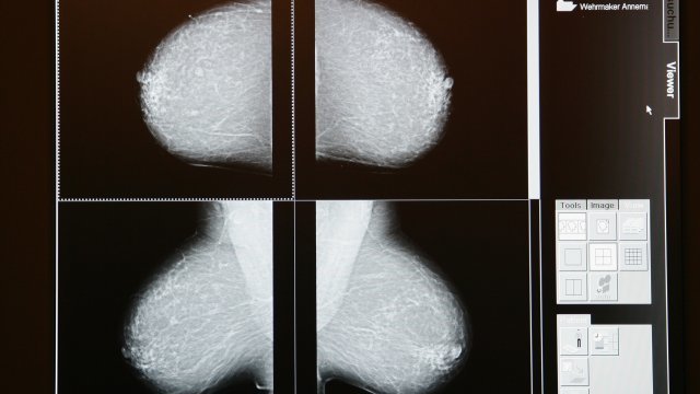 Digital image on a mammogram