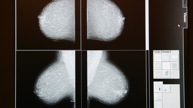 Mammogram image from breast cancer screening