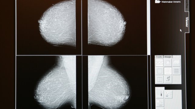 Mammogram scan