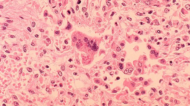 a histopathology of measles pneumonia