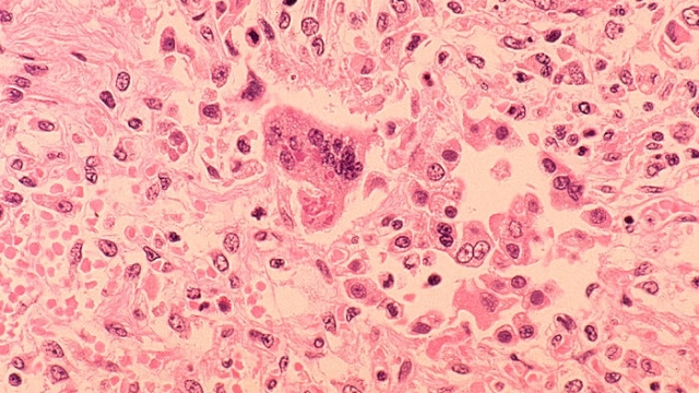 A histopathology of measles pneumonia is seen in this microscope image.