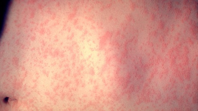 The skin of a patient infected with measles.