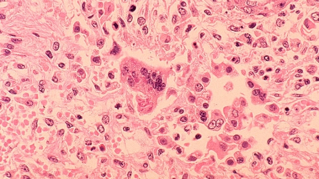 Measles as seen under a microscope