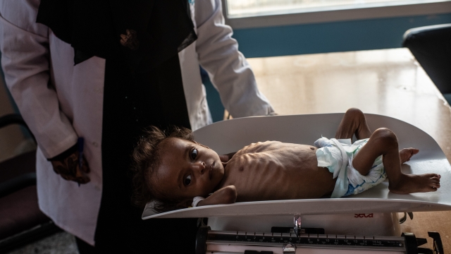 Child is treated for acute malnutrition in war-torn Yemen in 2018.