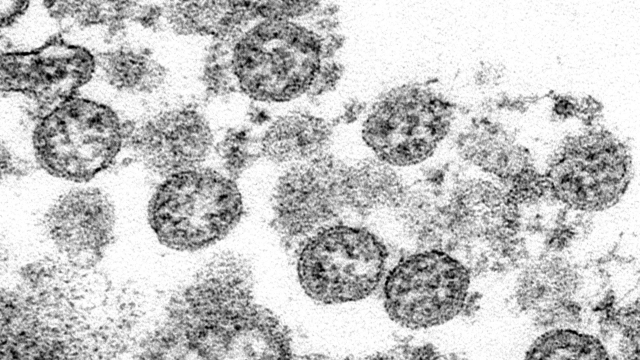A microscope image of the spherical coronavirus particles from the first U.S. case of COVID-19.