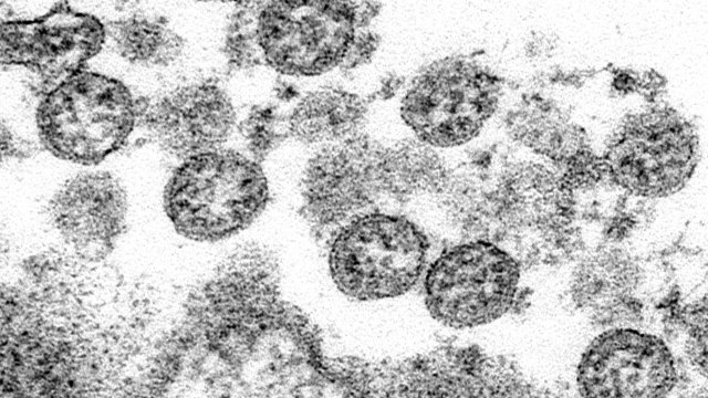 The spherical coronavirus particles from the first U.S. case of COVID-19.