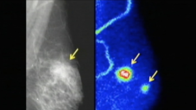 Photo of a mammogram
