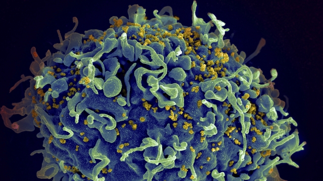 An electron microscope image of a human T cell infected by HIV, which is the virus that causes AIDS.