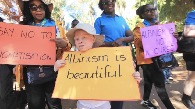 A person holds a sign saying, "Albinism is beautiful."