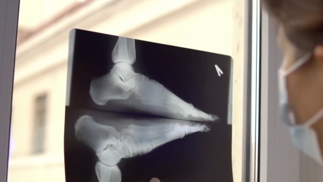 x-ray of a foot