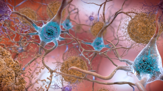 An illustration depicts cells in an Alzheimer’s affected brain
