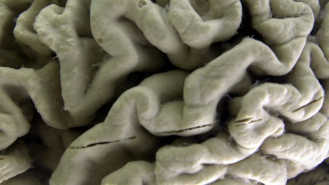 An image of a brain affected by Alzheimer's disease