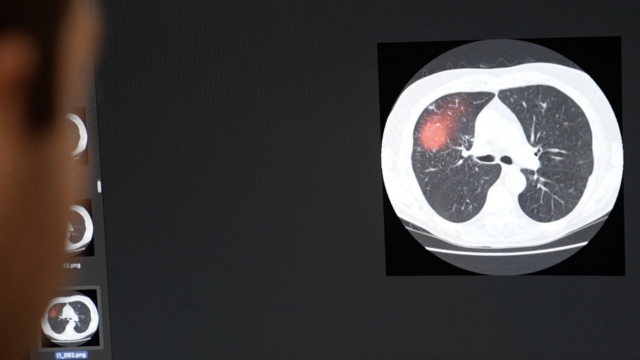 MIT researcher Peter Mikhael looks through CT scans of lungs