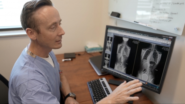 Doctor examines x-ray images of a person with scoliosis.
