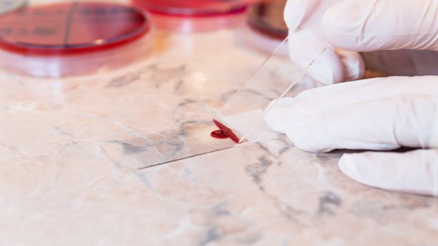 A laboratory doctor preparing a blood smear test.