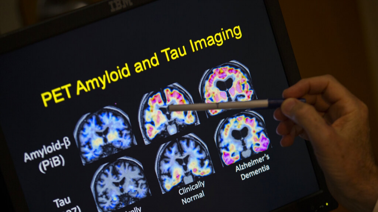 PET scan results that are part of a study on Alzheimer's disease.