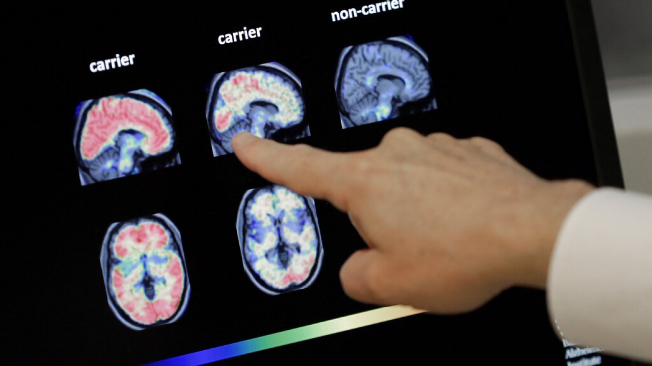 Brain scan of Alzheimer's patient