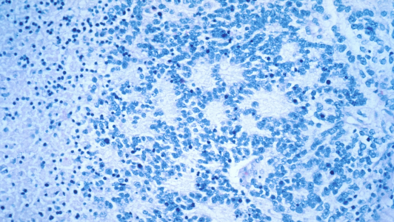 A microscope photo provided by the National Cancer Institute shows a typical neuroblastoma with rosette formation