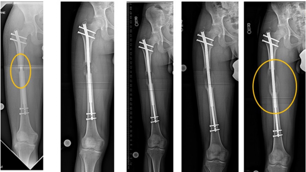 X-rays showing the limb-lengthening process.