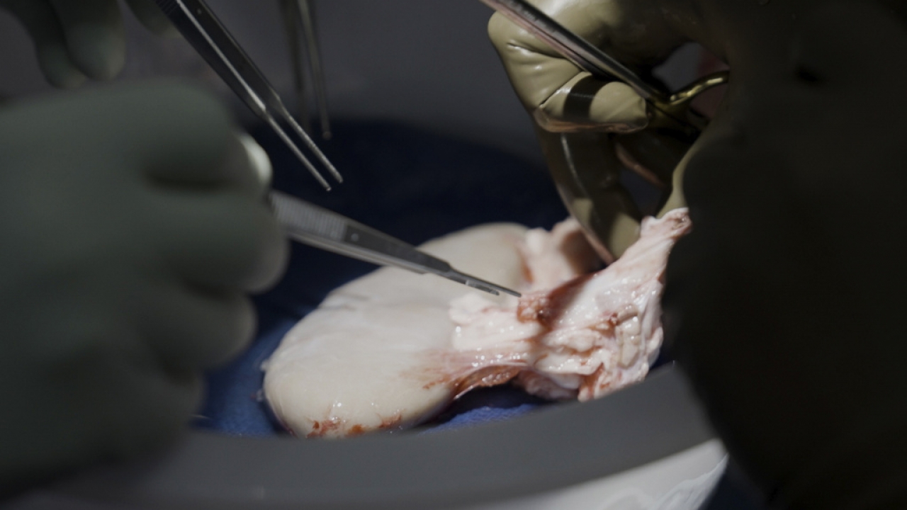 Surgeons at NYU Langone Health prepare to transplant a pig's kidney into a brain-dead man.