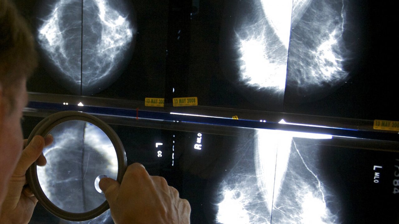 A radiologist uses a magnifying glass to check mammograms for breast cancer.