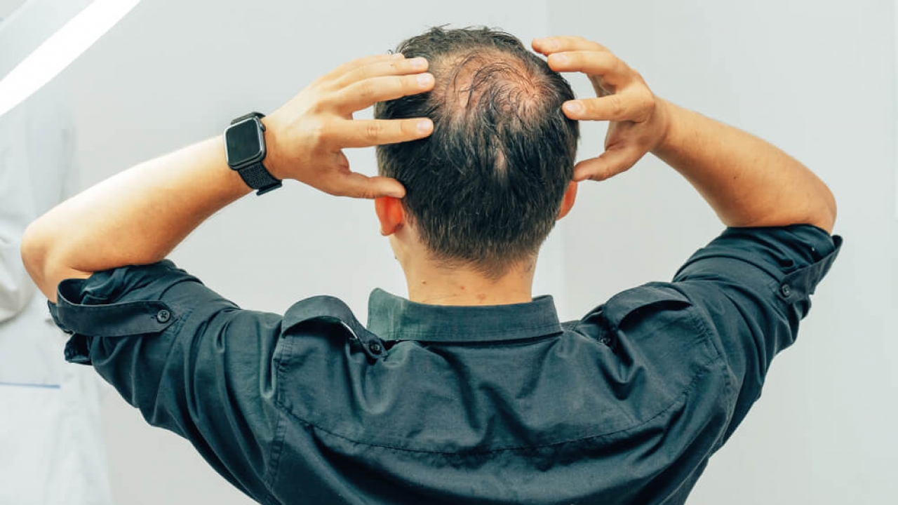 Man experience hair thinning/baldness.