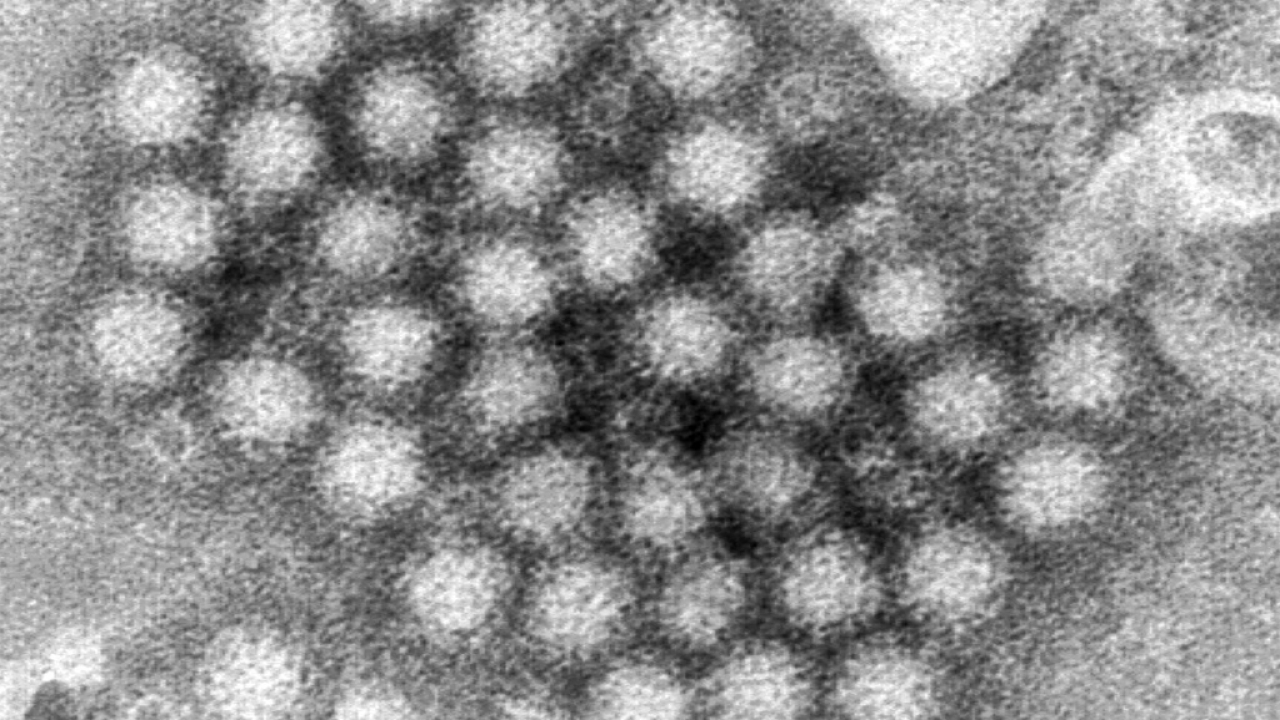 Norovirus surge in US causes over 1,000 students to miss school